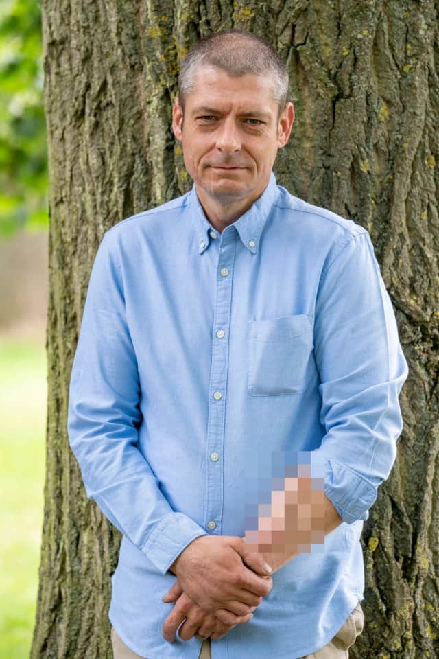 全球首位前臂长出生殖器的男人 背后原因令人意想不到 -2 全球首位前臂长出生殖器的男人 背后原因令人意想不到-NICEGAY