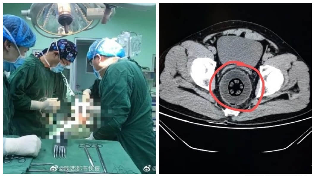 超狂男子腹痛6小时羞求医，直肠惊现20公分大木瓜：不小心塞进去的... -3