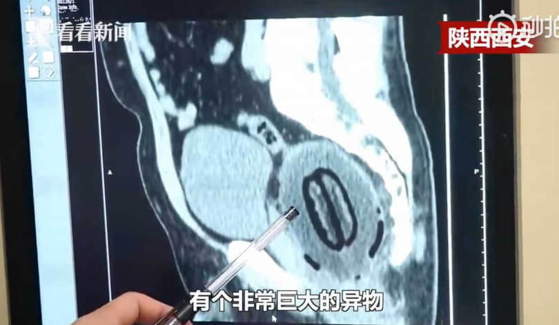 超狂男子腹痛6小时羞求医，直肠惊现20公分大木瓜：不小心塞进去的... -2